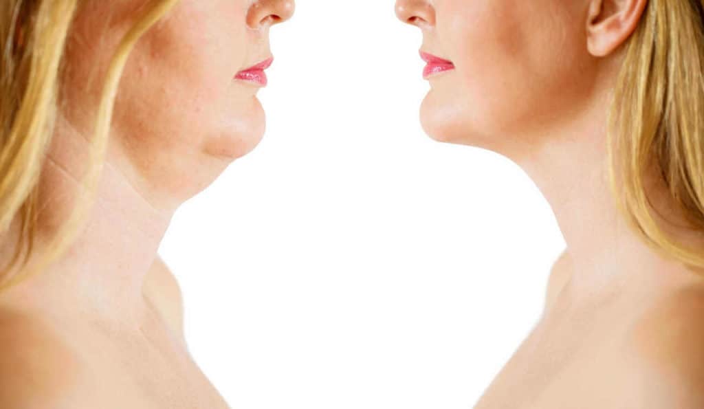 Double Chin treatment Wembley before and after results