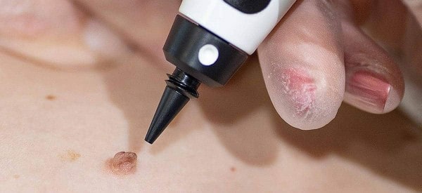After Skin Tag Removal Wembley