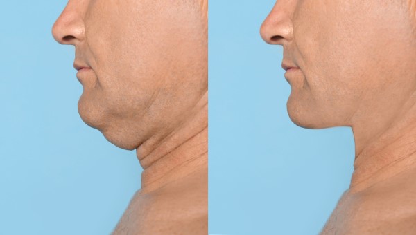 Which Non-Surgical Treatments Work Best for Jowls and Loose Skin Wembley?