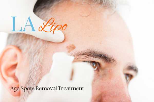 What Are the Most Effective Treatments for Age Spots Wembley?