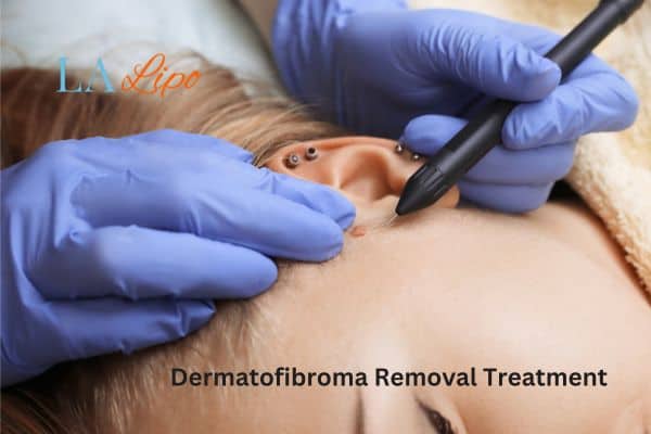 Dermatofibroma Removal Treatment Wembley