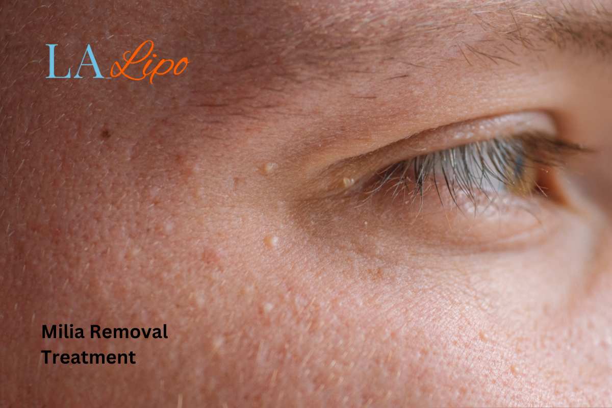 Cryopen Milia Removal: Is It the Easiest and Safest Option Wembley?