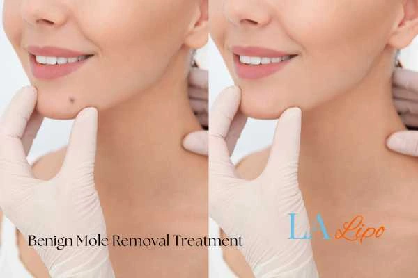 Before-and-after results following benign mole-removal treatment Wembley
