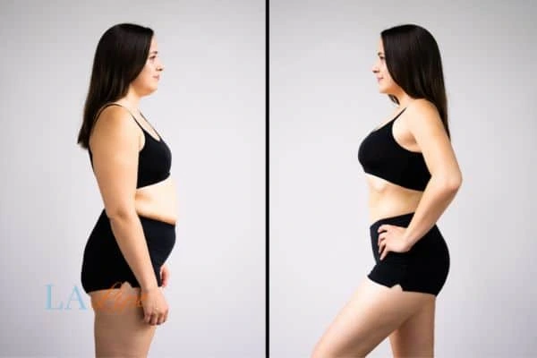 image of woman before and after results of LA-EMS Body Sculpting Wembley to help treat Diastasis recti