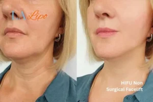 hi-fu for wrinkles Wembley before and after results