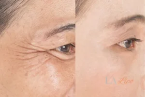 Before and after results of woman - HI-fu wrinkles reduction treatment Wembley