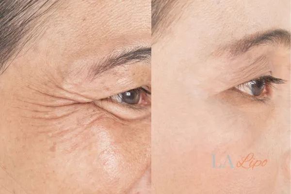 Before and after results of woman - HI-fu wrinkles reduction treatment Wembley