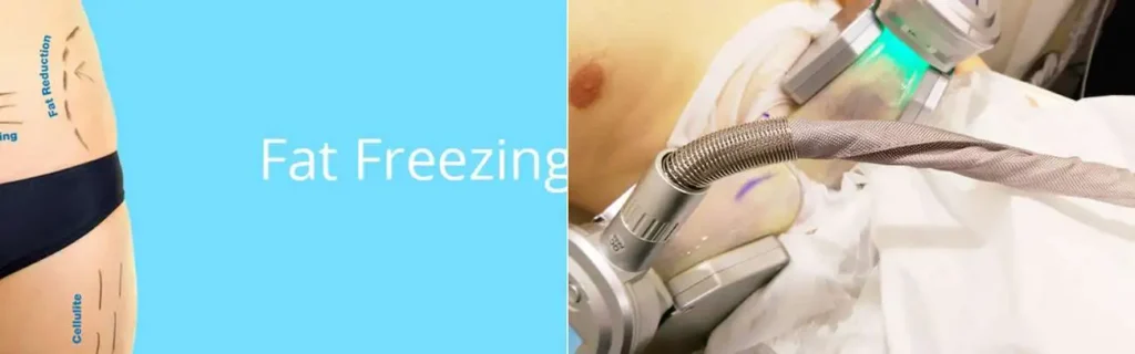 Fat freezing Wembley on multiple areas of the body