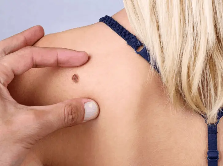 woman having mole removal Wembley consultation before treatment.