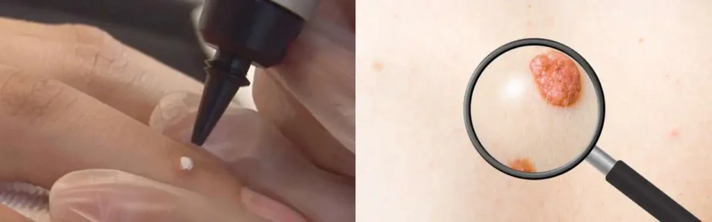 Cryopen for mole removal Wembley - speak to our team today!