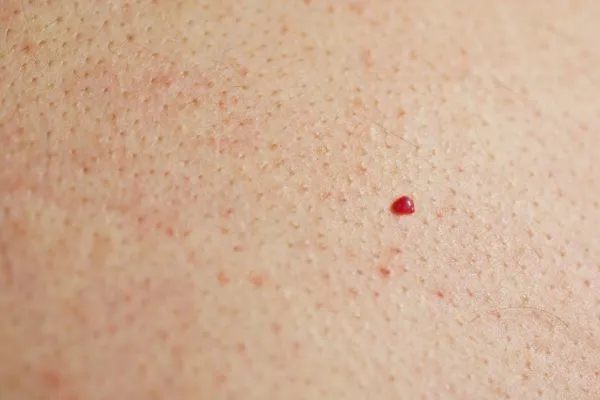 close up of a cherry angioma Wembley