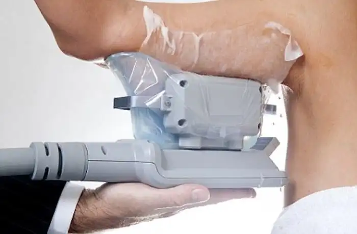 Picture of fat freezing Wembley on the upper arms.