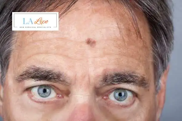 Solar Lentigo Removal Wembley image of man with mark on his forehead