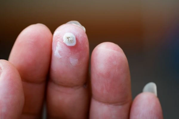wart on person finger - cryotherapy to treat from LA LIPO Wembley