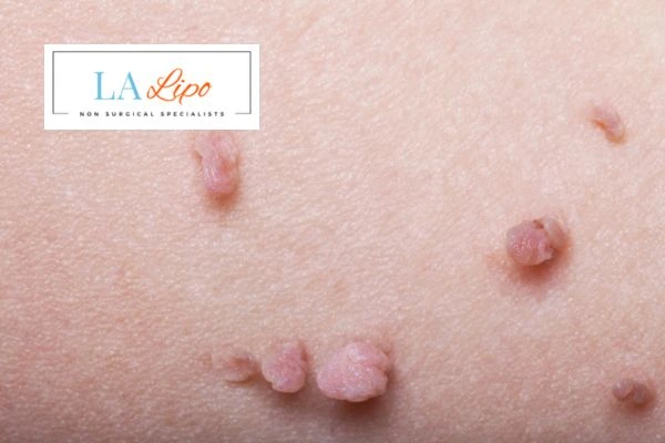 Does cryopen skin tag removal Wembley hurt? Find out now call our team today!