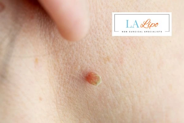Book skin tag removal Wembley today speak to our team now!