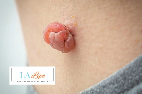 Interested in skin tag removal Wembley? Concerned about the pain? Find out more today!