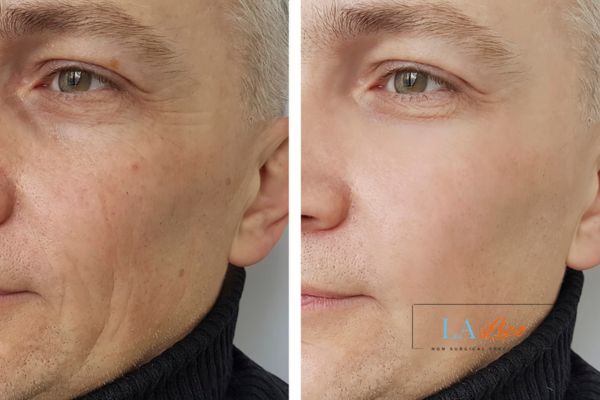 See the amazing results of Morpheus8 Treatment Wembley!