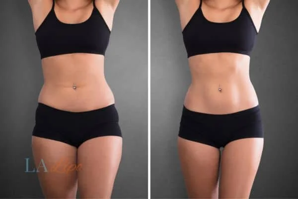 before and after results of non-surgical treatment to help a woman's body image and mental health Wembley
