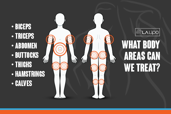 Diagram to show areas you can have LA-EMS Body Sculpting Treatment Wembley