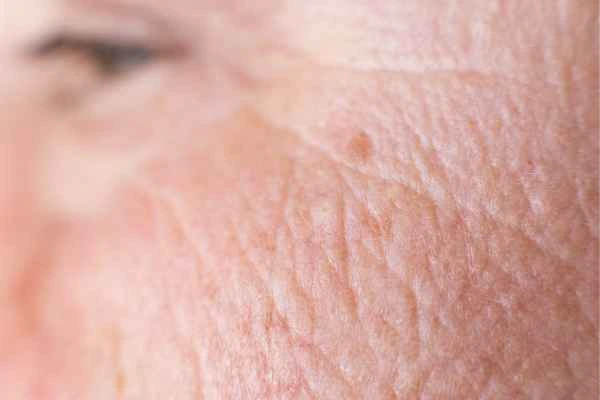 close up picture of a woman's face showing an age spot Wembley