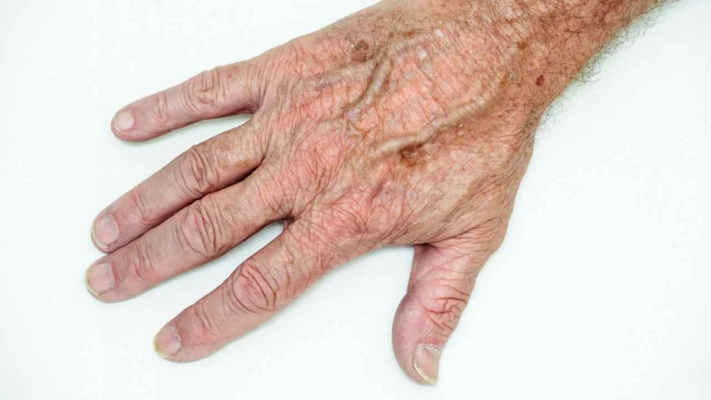 Male hand showing age spot Wembley