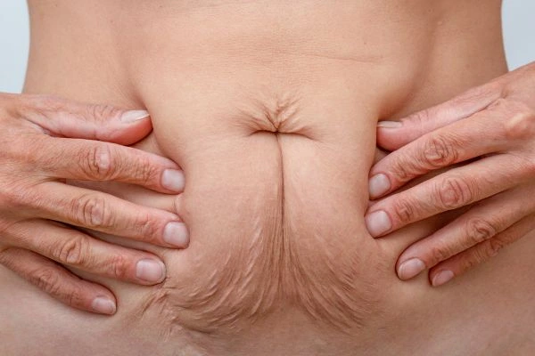 Image of a woman's stomach with loose skin - example of skin tightening Wembley options
