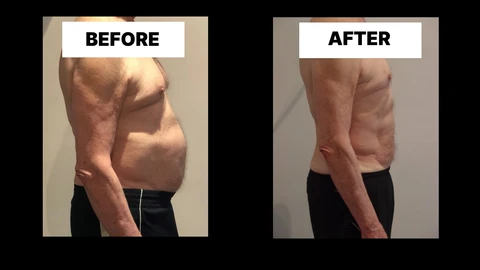 What Symptoms Can Diastasis Recti Cause in Men? Weak Core, Back Pain and Poor Posture Wembley